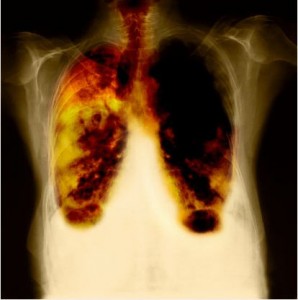 kanker paru-paru